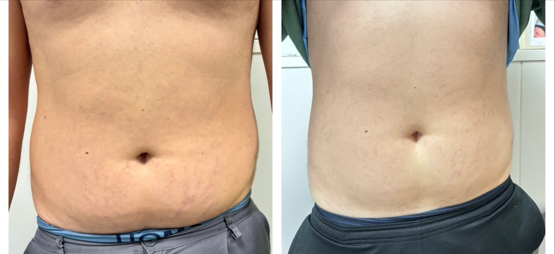 Antes y después de RSP-Tonic en abdomen masculino: zona más tonificada