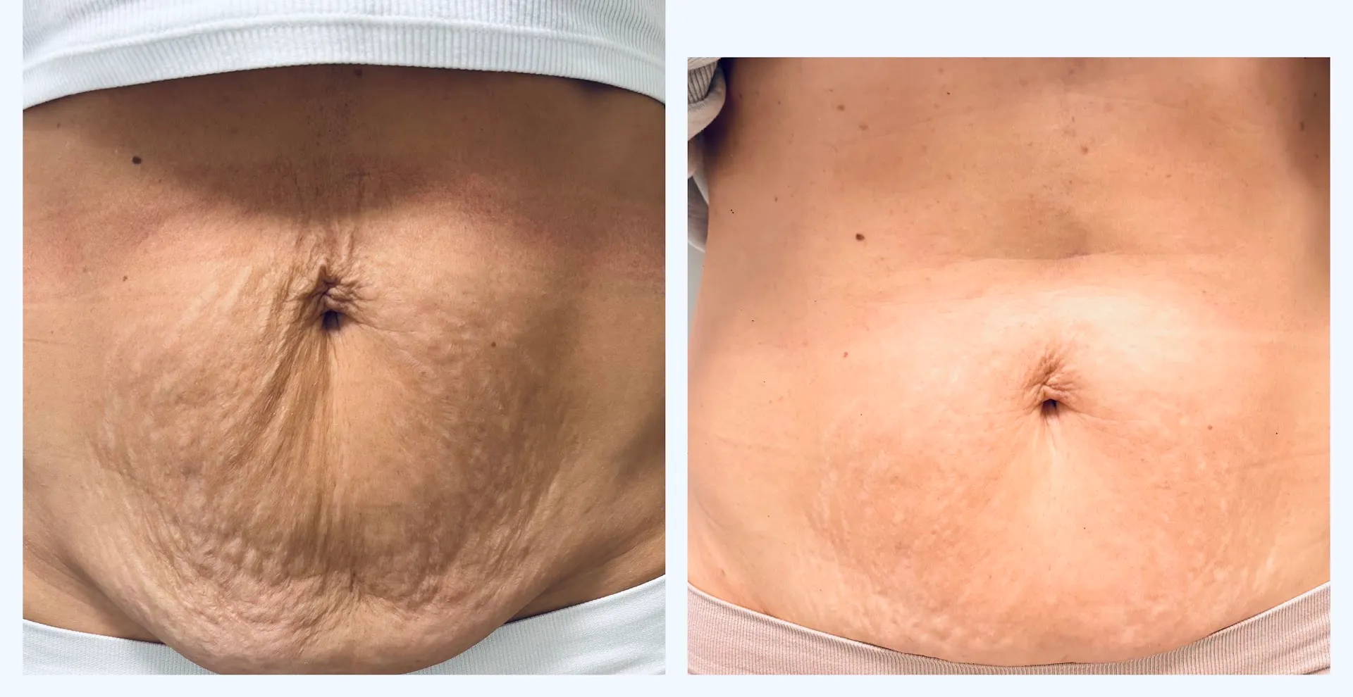 Antes y después de un tratamiento corporal reafirmante en el abdomen
