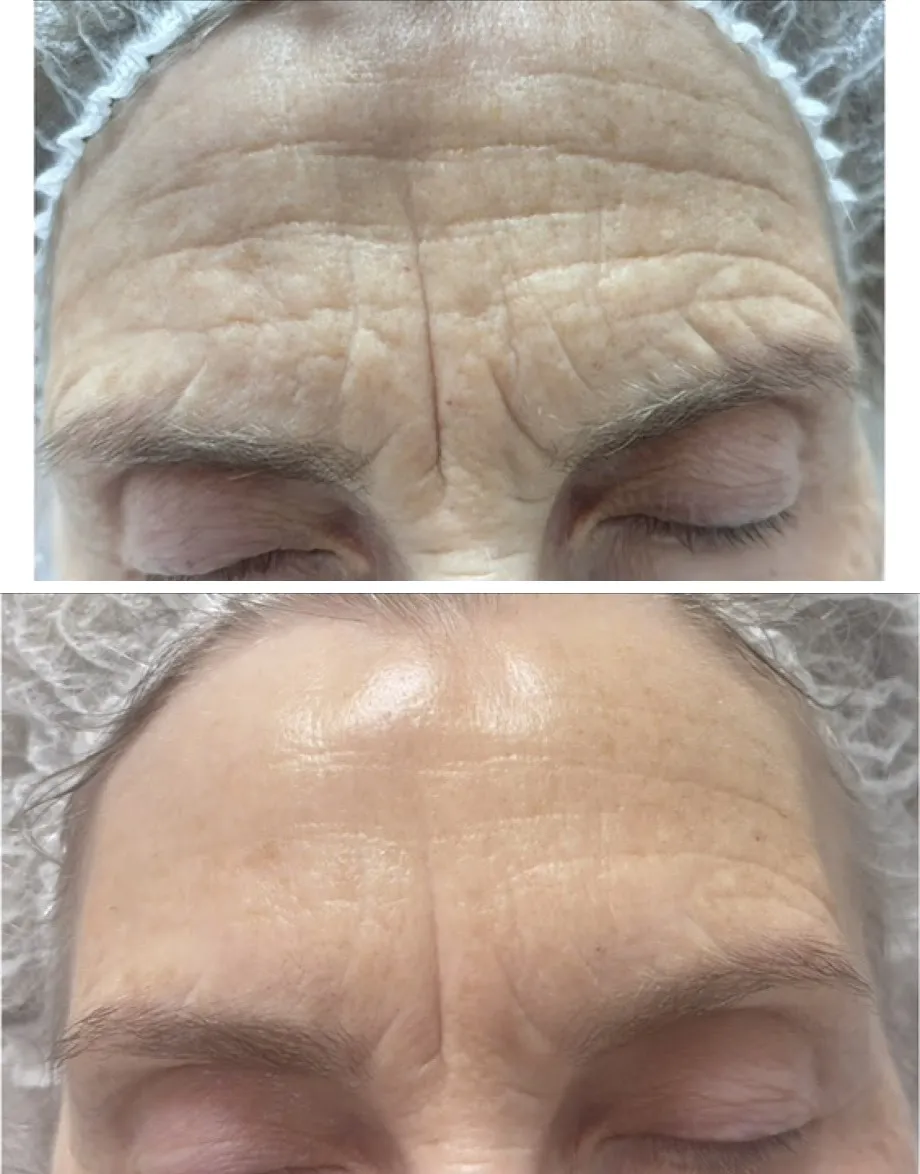 Antes y después de mesoterapia con exosomas en la frente: arrugas visiblemente reducidas
