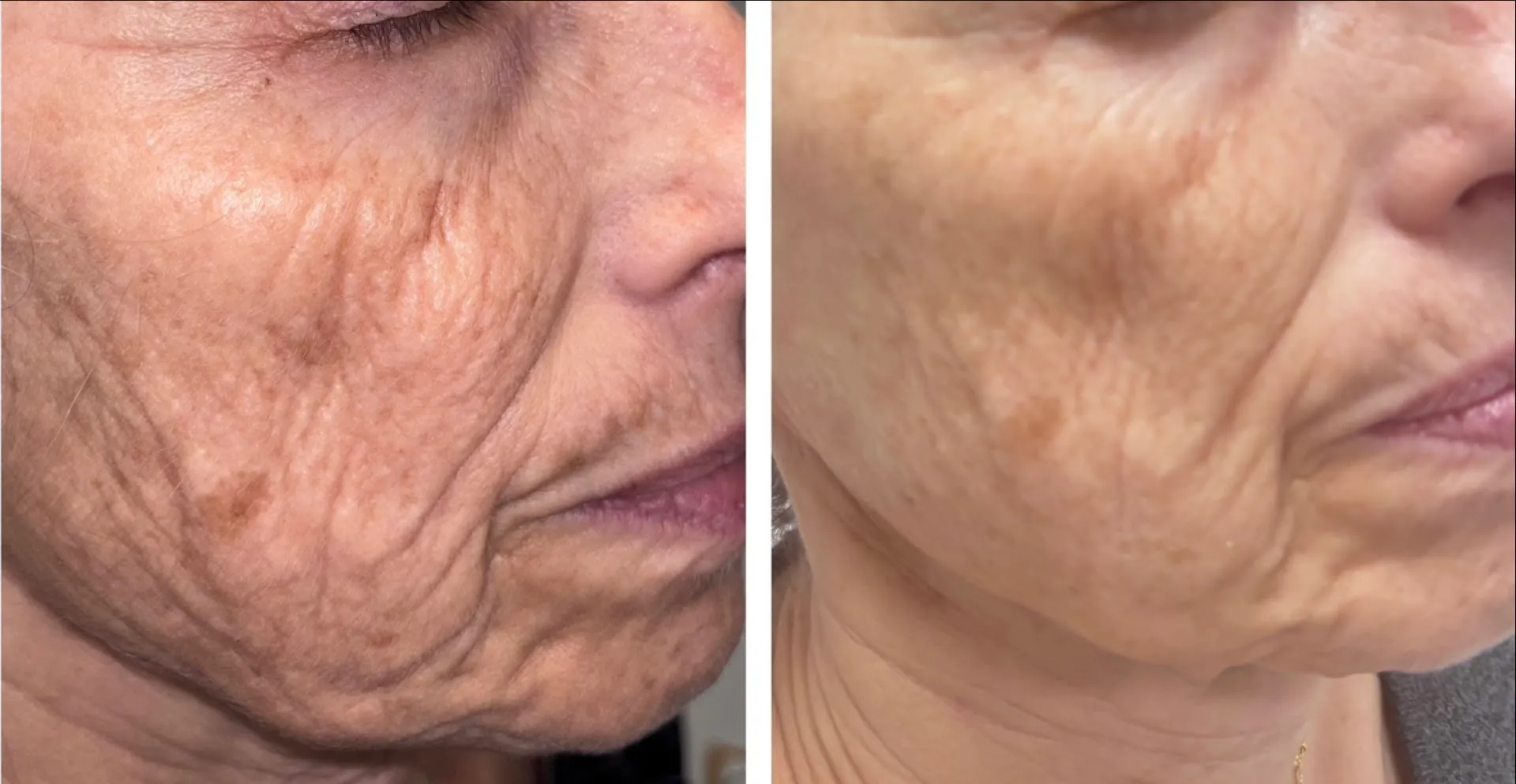 Antes y después de tratamiento con exosomas y retinal: manchas atenuadas y piel más uniforme